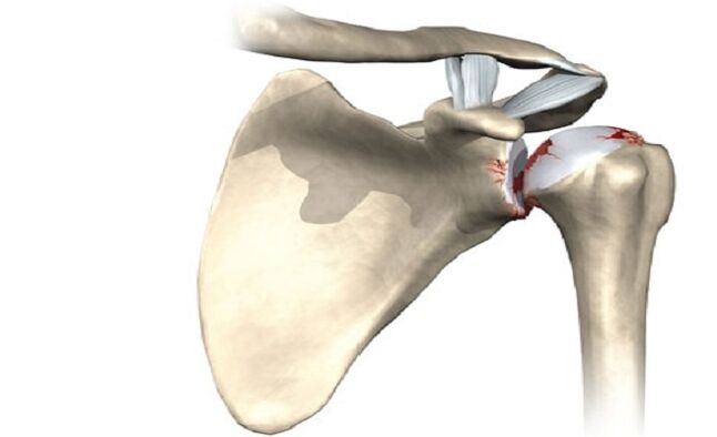 shoulder joint injury from arthrosis