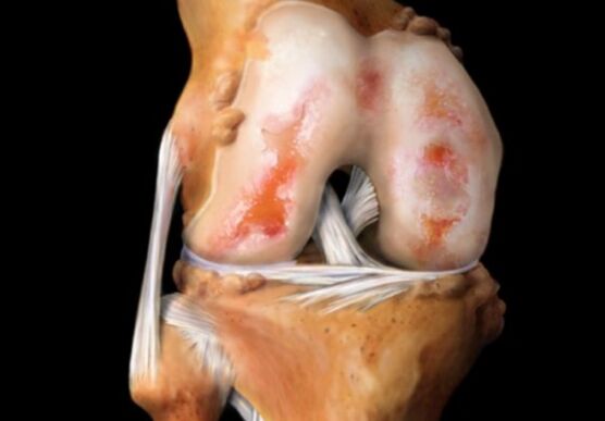 Cysts