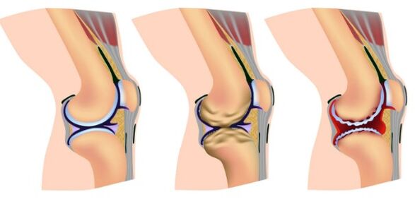 Deformation phase of the knee joint