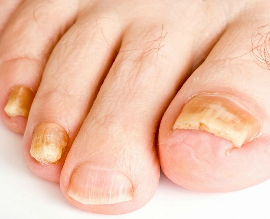 Mushroom on the nails
