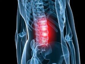 Lumbar column osteochondrosis