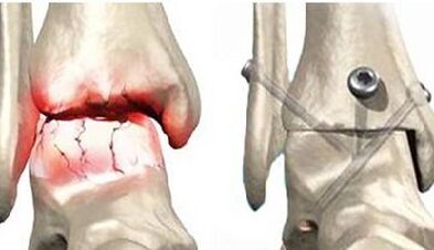 Surgical treatment of knee illegal