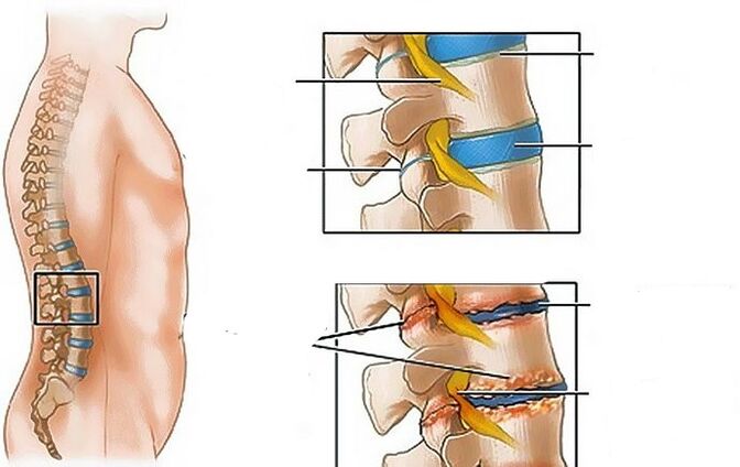Osteochondrosis of the lumbar region