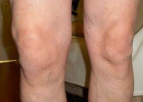 knee symptoms