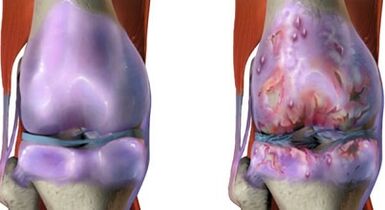 The main differences in arthritis and arthrosis