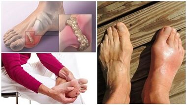 What is joint arthritis