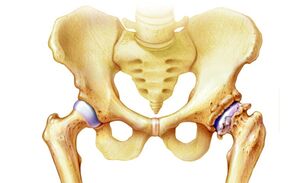 why arthrosis of the hip joint occurs