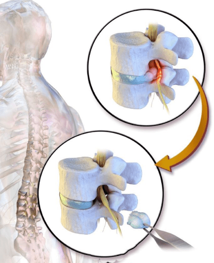 discectomy for back pain