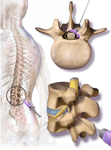 epidural injection of corticosteroids